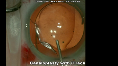 Thumbnail for entry Dr. Porter: Canaloplasty take 2