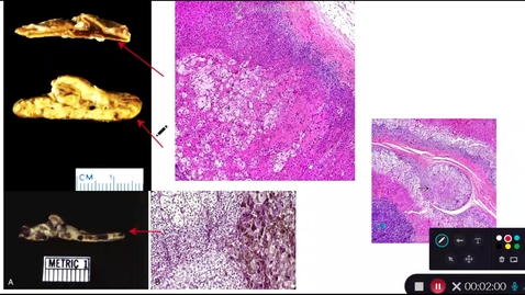 Thumbnail for Adrenal and Pituitary Gross and Histology Video 