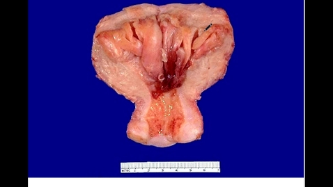 Thumbnail for GYN Lab Endometrium, Myometrium, Germ Cell Tumors
