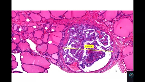 Thumbnail for entry Thyroid Parathyroid Lab - Thyroid Neoplasms