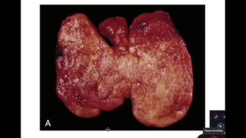 Thumbnail for Thyroid and Parathyroid Lab - Thyroiditis and Parathyroid Adenoma