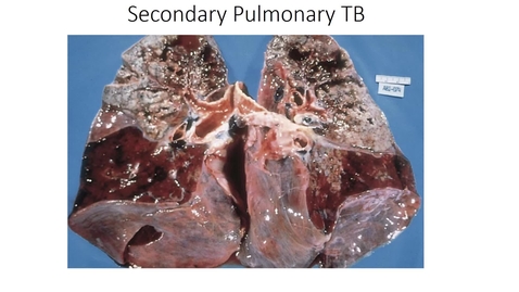 Thumbnail for Pulmonary infections