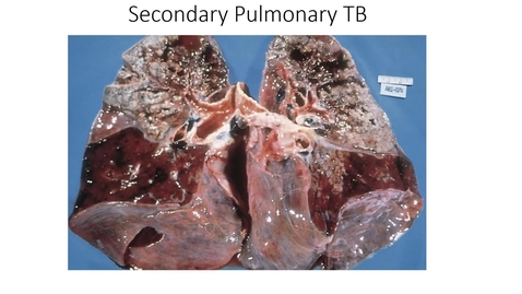 Thumbnail for entry Pulmonary infections