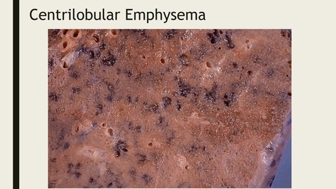 Thumbnail for Obstructive lung disease and mesothelioma