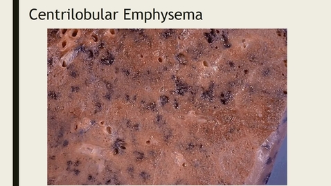 Thumbnail for entry Obstructive lung disease and mesothelioma