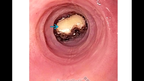 Thumbnail for entry Upper GI Esophagus and Stomach