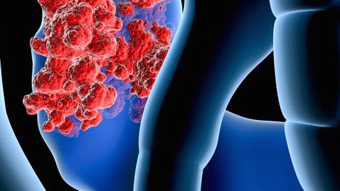 Thumbnail for entry Neuroendocrine Pancreatic Tumor Treatment Options