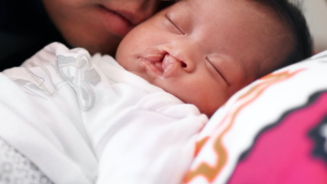 Thumbnail for A Cleft Team Can Improve Your Child’s Cleft Palate or Cleft Lip Treatment