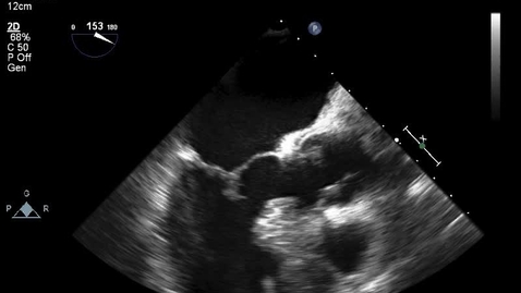 Thumbnail for HCM Clip 3. Pre myectomy