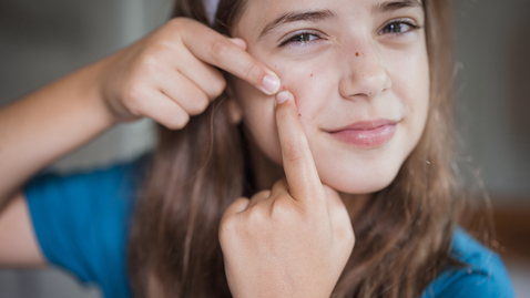Thumbnail for Debunking Old Wives' Tales: 5 Myths About Treating Acne