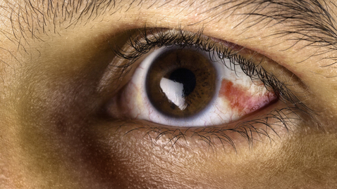 Thumbnail for Broken Blood Vessel in the Eye