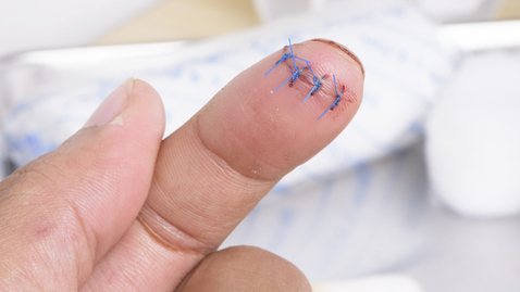 Thumbnail for Three Most Common Ways a Cut Can Land You in the ER