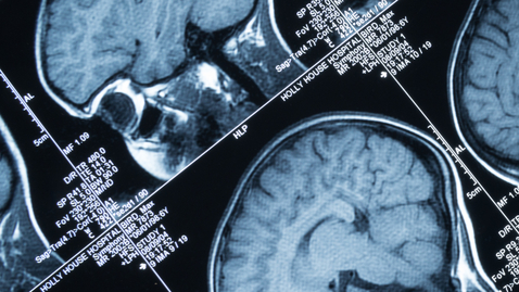 Thumbnail for Surgical Option to Treat Drug-Resistant Epilepsy