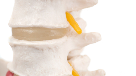 Thumbnail for Upper Back or Neck Pain? Maybe Your Spinal Cord is Being Compressed