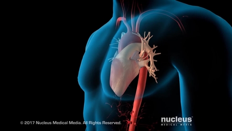 Thumbnail for Aortic Aneurysm and Aortic Dissection