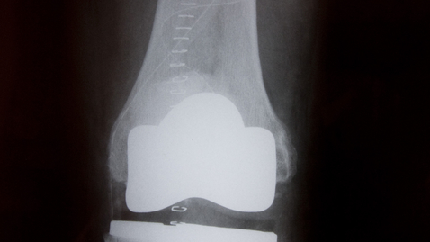 Thumbnail for Do You Need a Hip or Knee Revision?