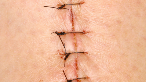 Thumbnail for Staples, Stitches or Glue for Treating Large Cuts?