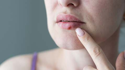 Thumbnail for Cold Sores: Causes, Treatments, and Prevention