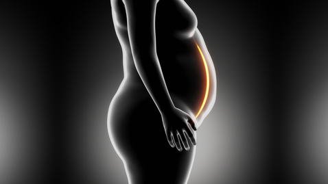 Thumbnail for Is Bariatric Surgery for You? 