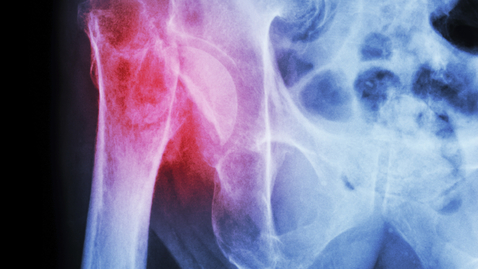 Thumbnail for You Can’t Cast It: Pelvic Fracture Treatment