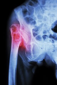 What are the surgical options for a pelvic fracture?