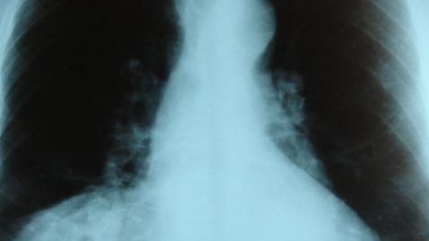 Thumbnail for What You Need to Know After a CDH Diagnosis