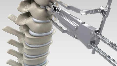 Thumbnail for What to Expect When Treating Spinal Scoliosis with Surgery