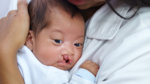 Thumbnail for New Strategy May Reduce Amount of Lifetime Cleft Palate Operations