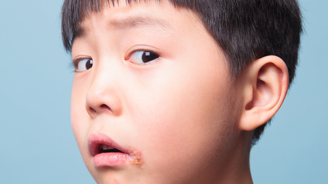 Thumbnail for How to Treat Your Child’s Cold Sore