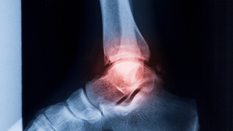 Thumbnail for My Ankle is Sprained—But is it Fractured, Too?