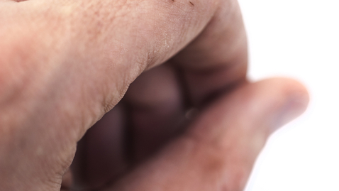 Thumbnail for Best Way to Remove a Splinter