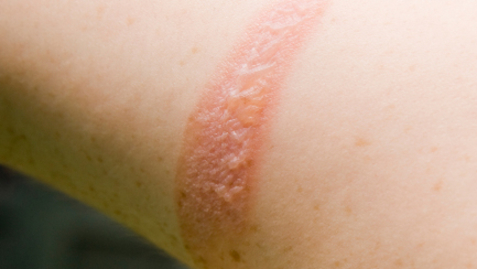 Thumbnail for entry Heating Pads Can Cause Second-Degree Burns