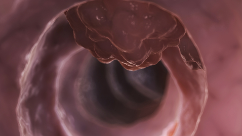 Thumbnail for Drug Treatment Prevents Polyps In High-Risk Cancer Patients