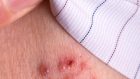 Thumbnail for Why You Need a Shingles Shot