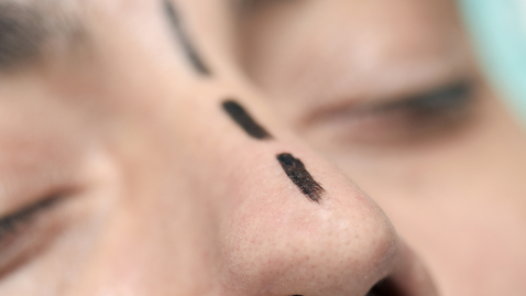 Thumbnail for Rhinoplasty to Improve Breathing
