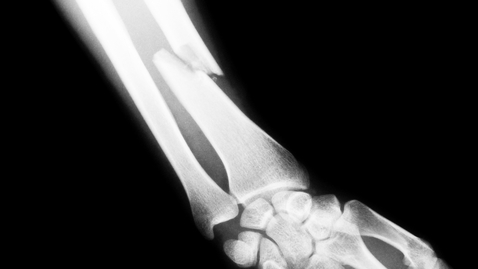 Thumbnail for entry Listener Question: What Should I Do About Bone Fractures?