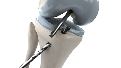 Thumbnail for Should You Have Your Knee Scoped After an Injury?