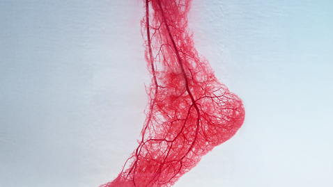 Thumbnail for How to Prevent and Treat Vascular Disease