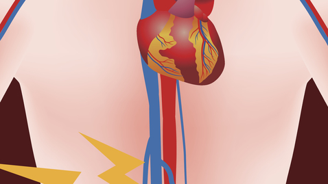 Thumbnail for Am I At Risk for an Abdominal Aortic Aneurysm?