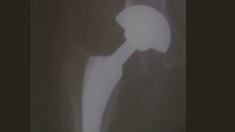 Thumbnail for Total Hip Replacement