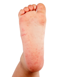 It S Not Strep Throat Treating Hand Foot And Mouth Disease University Of Utah Health