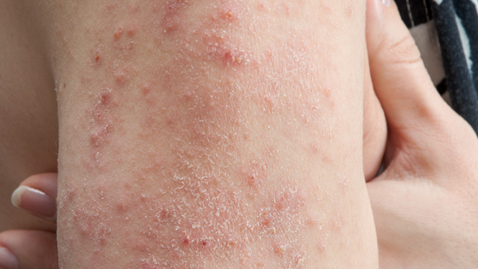 Thumbnail for I’m Not Sure Why I Keep Getting Hives