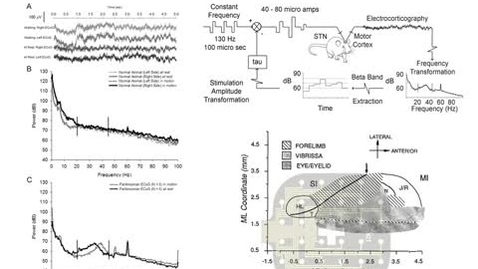 Thumbnail for Biomarker-controlled deep brain stimulation for Parkinson's disease