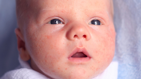 Thumbnail for What Does it Mean if My Newborn Has Acne?