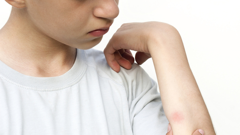 Thumbnail for Debunking Old Wives' Tales: Bug Bites