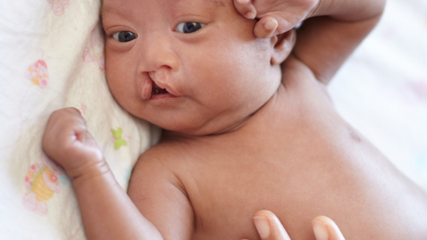 Thumbnail for Treating a New Baby’s Cleft Lip