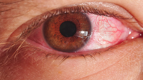 Thumbnail for What's Up with Bob's Eye?