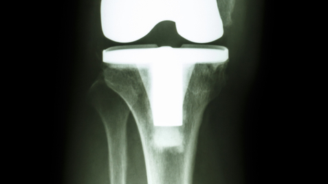 Thumbnail for Preparing for a Knee or Hip Replacement Procedure