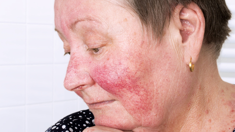 Thumbnail for Rosacea Signs and Symptoms