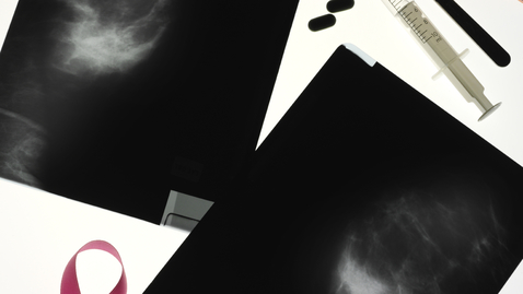 Thumbnail for Am I Normal: My Mammogram Results Say I Have Dense Breast Tissue